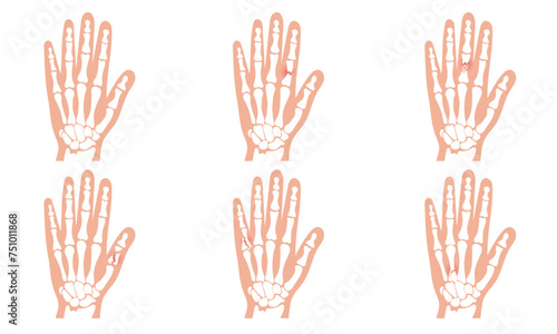 Hand and broken hand bone skeletons. Broken arm, ulna and radius, injuries arm, Significant trauma, falls