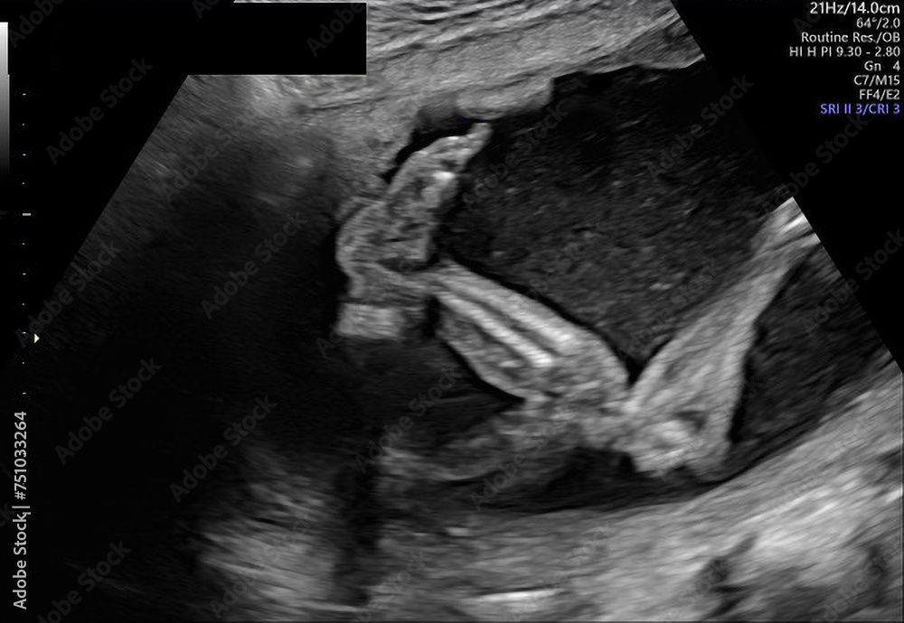 Baby Boy (Male) SONOGRAM Series: Different Angles of Growing in Womb Baby Boy (Male) SONOGRAM Series: Different Angles of Growing in Womb