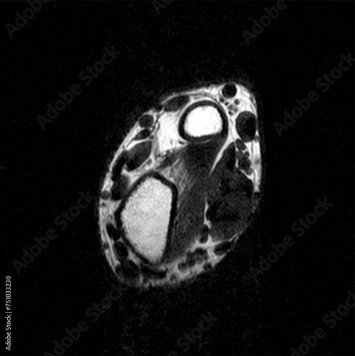 Partial MRI Scan of Broken Left Wrist Series A #04/24