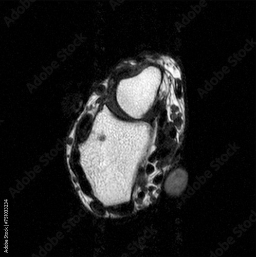 Partial MRI Scan of Broken Left Wrist Series A #09/24 photo