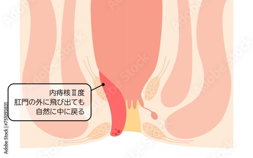 肛門の病気、痔・いぼ痔「内痔核Ⅱ度」　図解イラスト、断面図