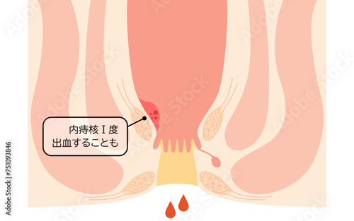 肛門の病気、痔・いぼ痔「内痔核Ⅰ度」　図解イラスト、断面図