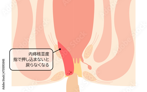肛門の病気、痔・いぼ痔「内痔核Ⅲ度」　図解イラスト、断面図