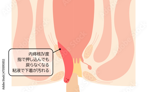 肛門の病気、痔・いぼ痔「内痔核Ⅳ度」　図解イラスト、断面図