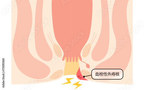 肛門の病気、痔・いぼ痔「血栓性外痔核」　図解イラスト、断面図
