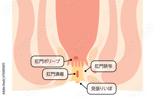 肛門の病気、痔「肛門潰瘍、肛門狭窄、肛門ポリープ」　図解イラスト、断面図