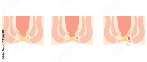 肛門の病気、痔「あな痔（痔ろう）」　図解イラスト、断面図