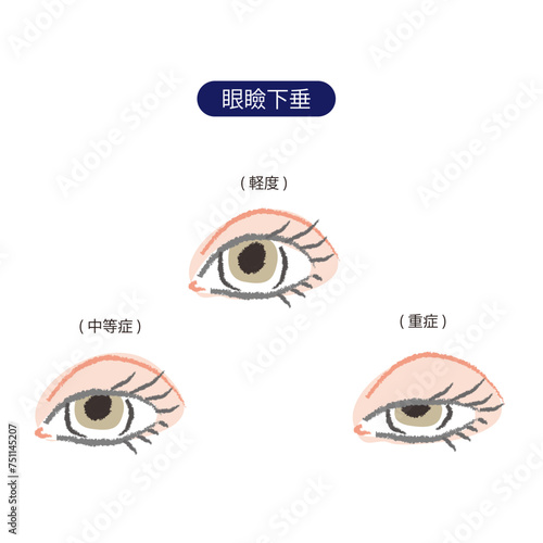 3段階(軽度、中等症、重症)の眼瞼下垂の目