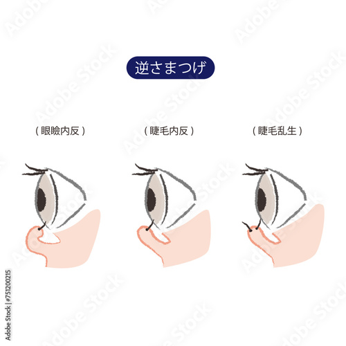 3種類(眼瞼内反、睫毛内反、睫毛乱生)の逆さまつげ