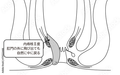 肛門の病気、痔・いぼ痔「内痔核Ⅱ度」　図解イラスト、断面図