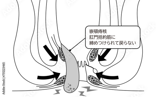 肛門の病気、痔・いぼ痔「嵌頓痔核」　図解イラスト、断面図