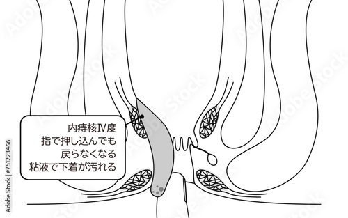 肛門の病気、痔・いぼ痔「内痔核Ⅳ度」　図解イラスト、断面図