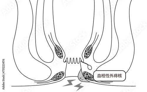 肛門の病気、痔・いぼ痔「血栓性外痔核」　図解イラスト、断面図