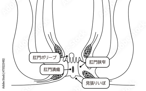 肛門の病気、痔「肛門潰瘍、肛門狭窄、肛門ポリープ」　図解イラスト、断面図