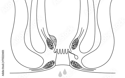 肛門の病気、痔・いぼ痔「内痔核Ⅰ度」　図解イラスト、断面図