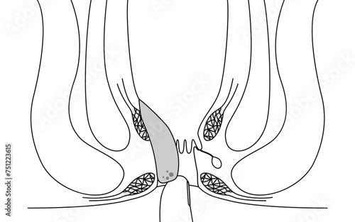 肛門の病気、痔・いぼ痔「内痔核Ⅲ度」　図解イラスト、断面図