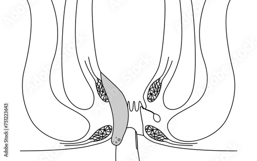 肛門の病気、痔・いぼ痔「内痔核Ⅳ度」　図解イラスト、断面図
