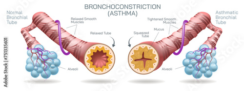 Bronchitis is an inflammation of the bronchial tubes, which are the air passages that carry air to the lungs. It can be either acute or chronic vector illustration