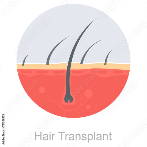 Hair transplant