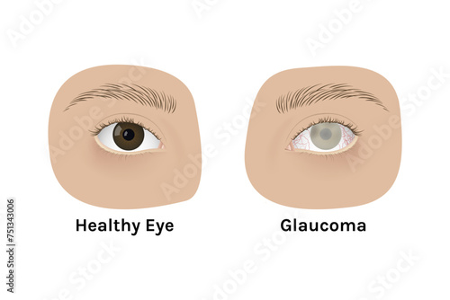 Realistic human healthy eye and with glaucoma vector illustration design.