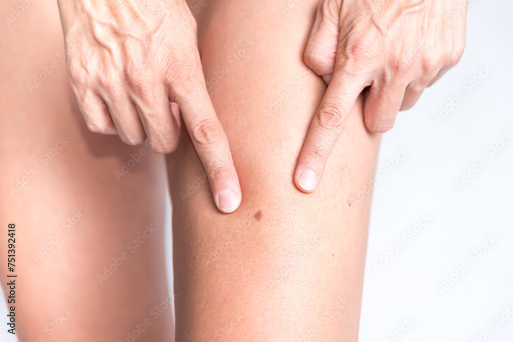 Strange mole on leg, skin spots. Strange mole on leg, skin spots.