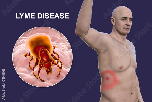A man with erythema migrans, a characteristic rash of Lyme disease caused by Borrelia burgdorferi, 3D illustration photo