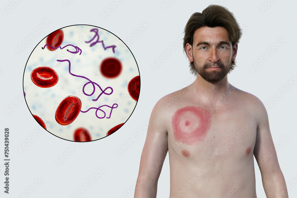 Characteristic Rash Mor A man with erythema migrans, a characteristic rash of Lyme disease ...