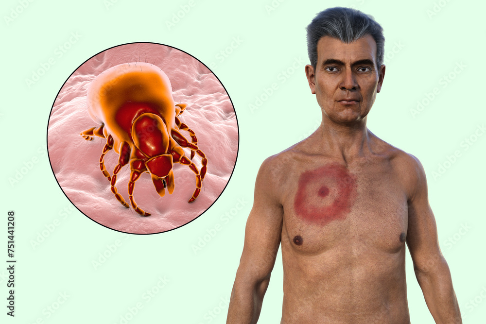 A man with erythema migrans, a characteristic rash of Lyme disease caused by Borrelia burgdorferi, 3D illustration - obrazy, fototapety, plakaty 
