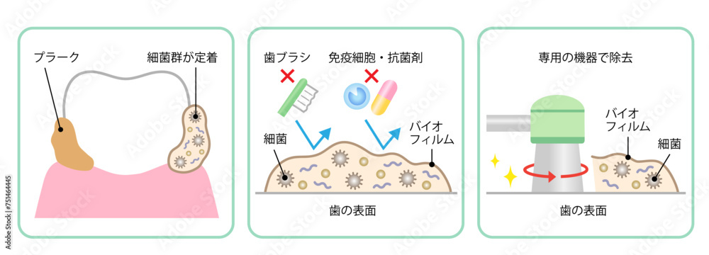 Obraz premium 歯のバイオフィルム除去