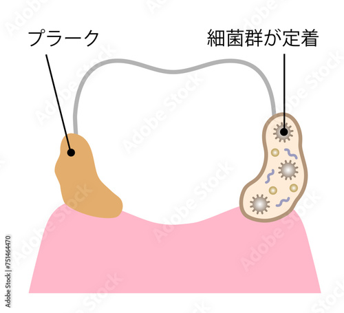 歯のバイオフィルム