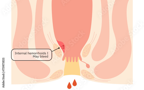 Diseases of the anus, hemorrhoids and warts "Internal hemorrhoids, degree I" Illustration, cross-sectional view