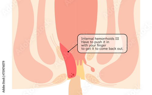 Diseases of the anus, hemorrhoids and warts "Internal hemorrhoids, degree III" Illustration, cross-sectional view