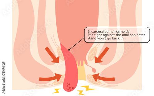 Diseases of the anus, hemorrhoids and warts "Fitting hemorrhoids" Illustration, cross-sectional view