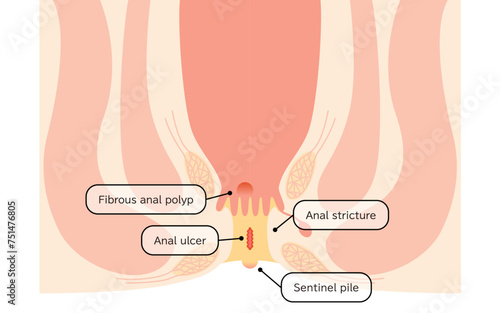Diseases of the anus, hemorrhoids "anal ulcer, anal stenosis, anal polyp" Illustration, cross-sectional view