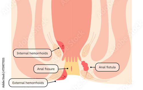 Diseases of the anus, hemorrhoids, warts, cut hemorrhoids, anorectal hemorrhoids Illustration, cross-sectional view