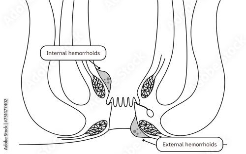 Diseases of the anus, hemorrhoids and warts Illustrations, cross-sectional views