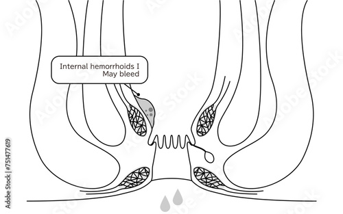 Diseases of the anus, hemorrhoids and warts "Internal hemorrhoids, degree I" Illustration, cross-sectional view