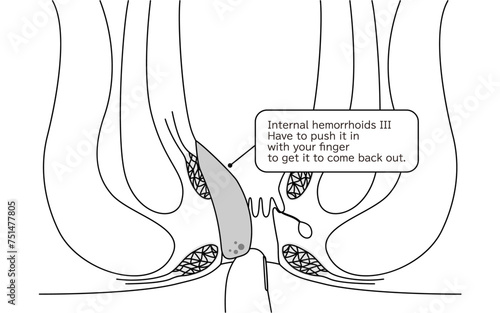 Diseases of the anus, hemorrhoids and warts "Internal hemorrhoids, degree III" Illustration, cross-sectional view