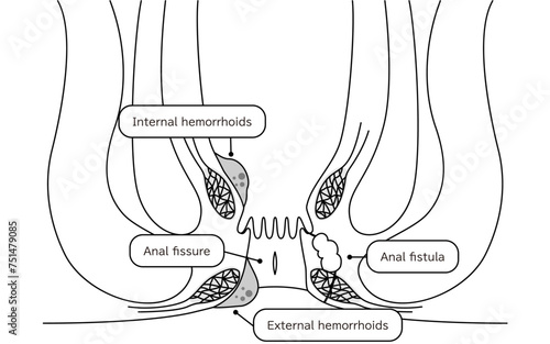 Diseases of the anus, hemorrhoids, warts, cut hemorrhoids, anorectal hemorrhoids Illustration, cross-sectional view