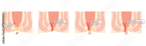 Diseases of the anus, hemorrhoids and warts "Internal hemorrhoids I-IV degree" Illustration, cross-sectional view