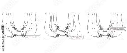 Diseases of the anus, hemorrhoids "Anorectal hemorrhoids" Illustration, cross-sectional view