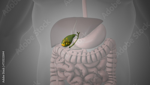 Medical animation showing gallstones in the gallbladder photo