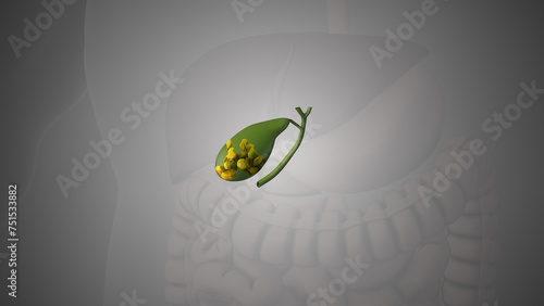 Medical animation showing gallstones in the gallbladder photo