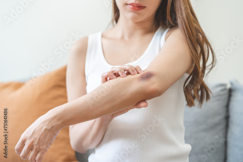 Close up of stain bruise wound on arm, contusion asian young woman, girl an accident fell down stairs, hand on elbow in healing injury by massage hematoma blood. Extravasation blue, purple on skin.