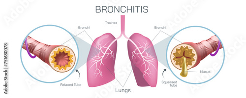 Bronchitis is an inflammation of the bronchial tubes, which are the air passages that carry air to the lungs. It can be either acute or chronic vector illustration