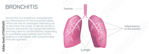 Bronchitis is an inflammation of the bronchial tubes, which are the air passages that carry air to the lungs. It can be either acute or chronic vector illustration