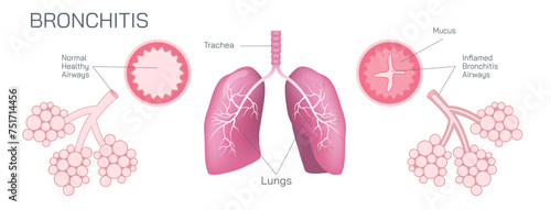 Bronchitis is an inflammation of the bronchial tubes, which are the air passages that carry air to the lungs. It can be either acute or chronic vector illustration