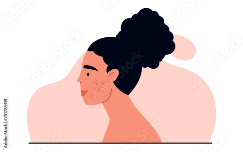 Couperose concept. Rosacea or superficial capillaries on woman face. Facial redness. Dermatology treatment and skincare. Isolated vector illustration in cartoon