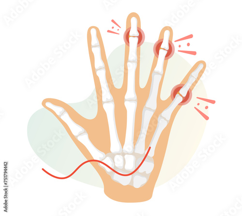 Inflamation - Finger Joint Pain as Stock Illustration