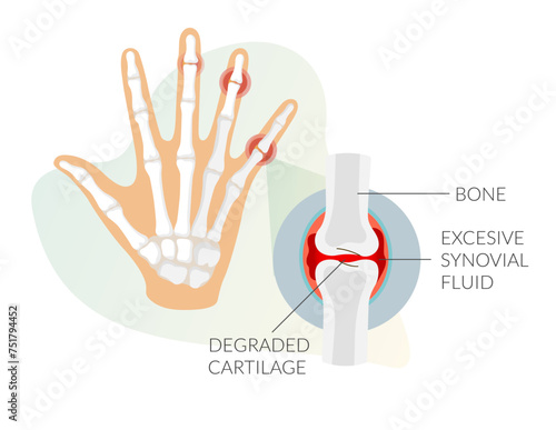 Inflamation - Finger Joint Pain as Stock Illustration